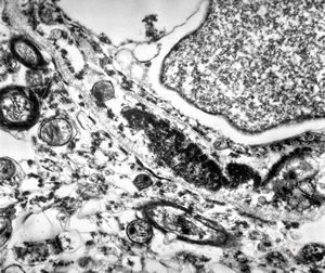 M,71y. | Alzheimer diseaseaccompanied with CADASIL M,71y. | Alzheimer diseaseaccompanied with CADASIL